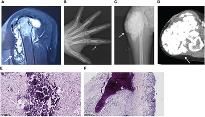 A novel FGF23 mutation in hyperphosphatemic familial tumoral calcinosis and its deleterious effect on protein O-glycosylation